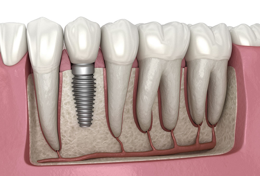 Things You Should Know About Dental Implants