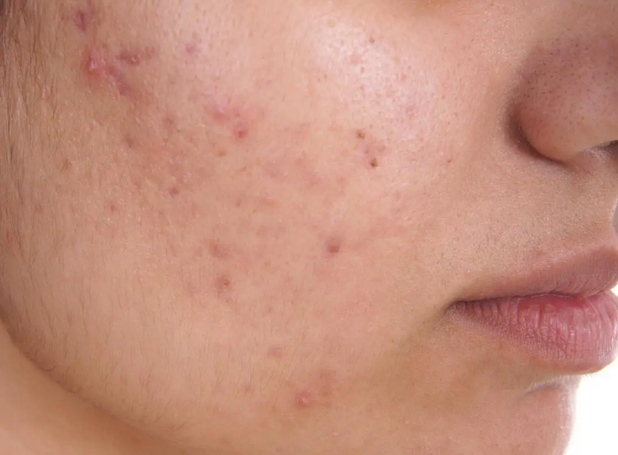 Home Remedies For Pimples Problem of Teenagers