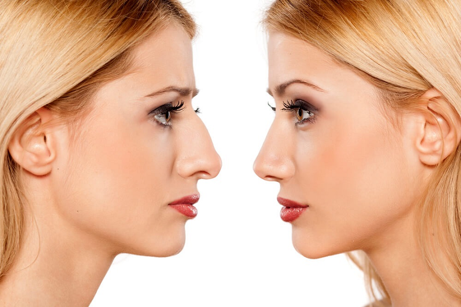 A Few Essential Factors To Know About Nose Surgery