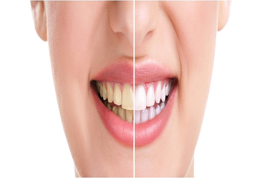 Attractive Benefits about Teeth Whitening that You Don’t Know