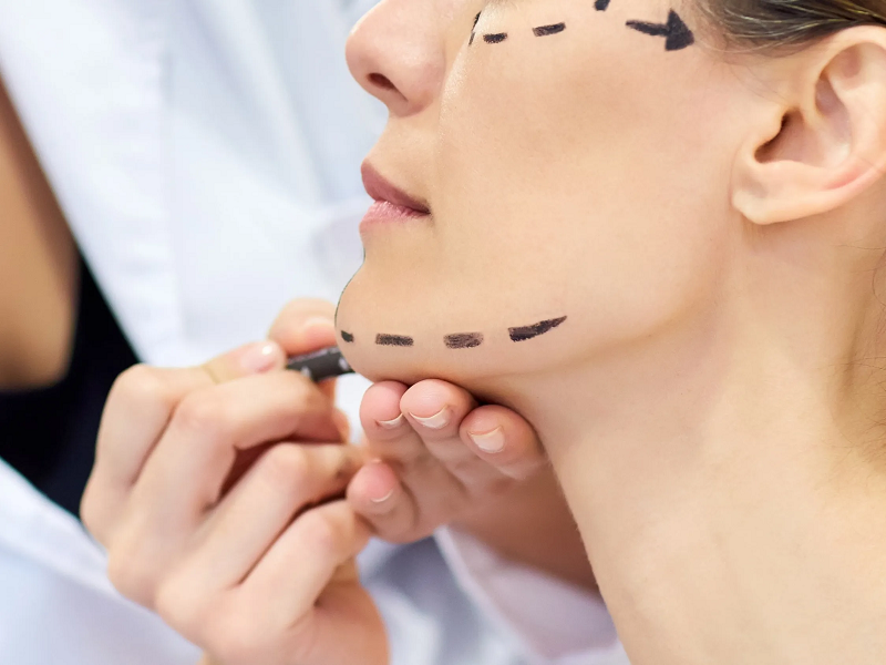 Why Should You Choose Facial Thread Lifting?