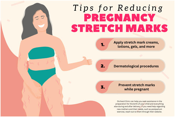 Tips for Reducing Pregnancy Stretch Marks