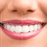 Smile Transformation Identifying Ideal Candidates For Braces And Orthodontic Treatment