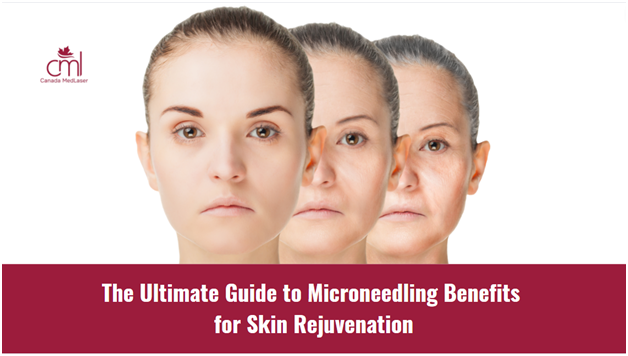 The Ultimate Guide to Microneedling Benefits for Skin Rejuvenation