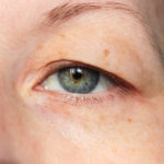 Double Eyelid Surgery Can Give You Beautiful Eyes If You Get Consulted Correctly