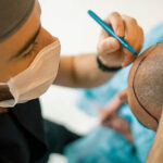 Criteria To Choose The Best Hair Transplant Surgeon in Delhi NCR