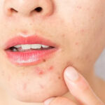 Effective Solutions to Tackle Pimples for All Ages