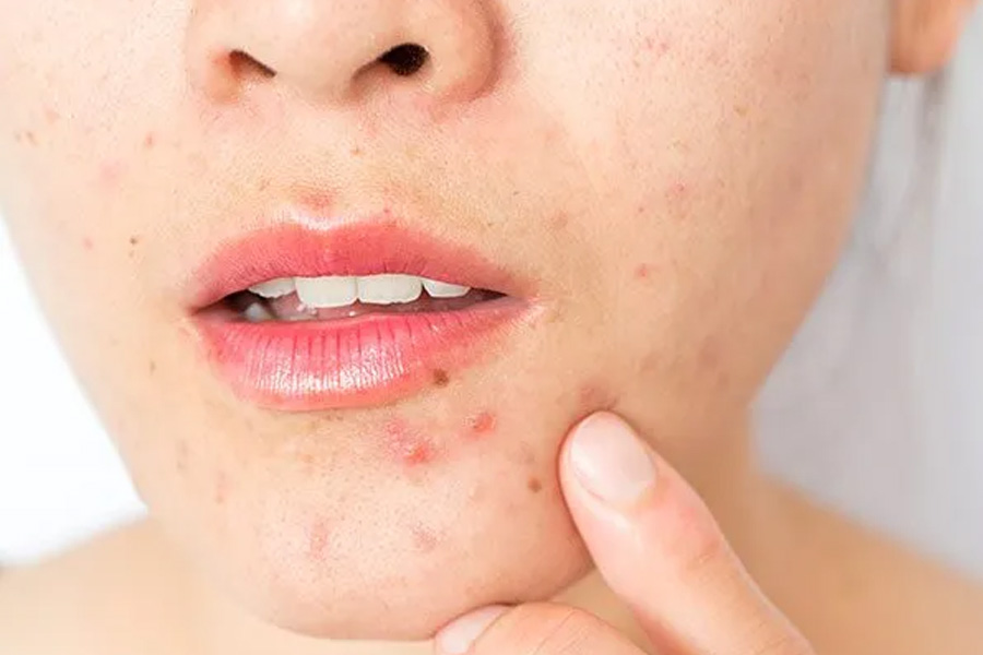 Effective Solutions to Tackle Pimples for All Ages